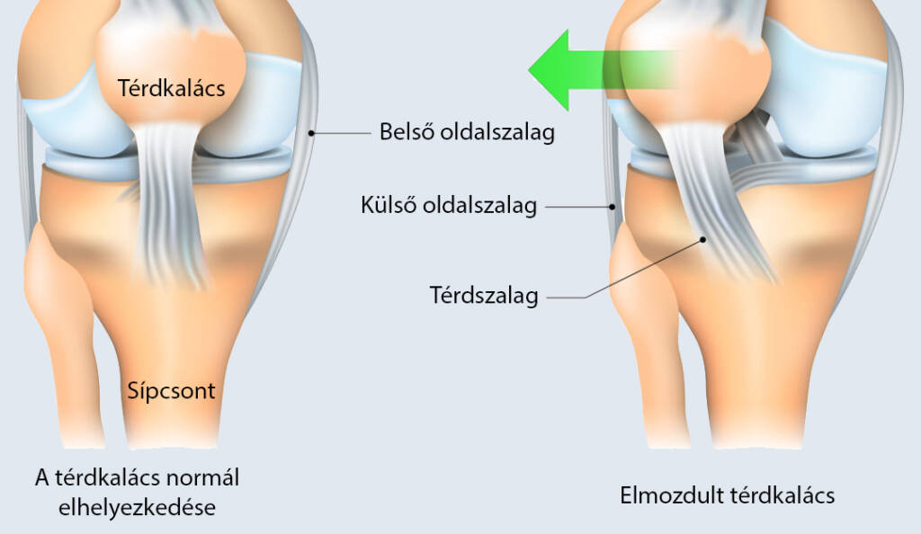 Patella térdkalács-elmozdulás