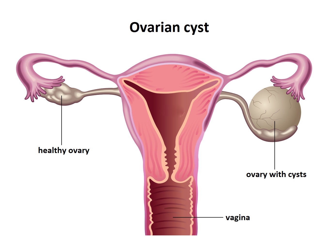 Ovarian cyst