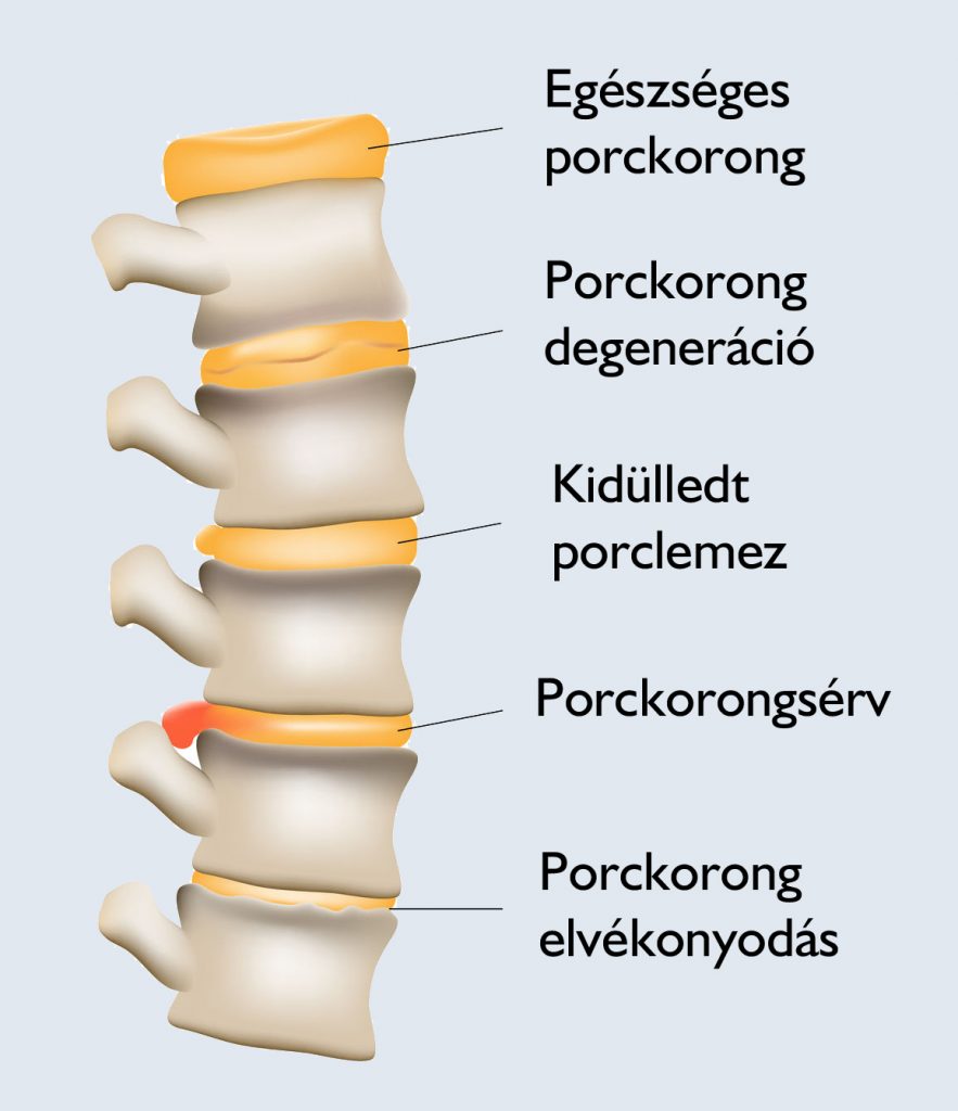 Lézeres porckorong dekompresszió