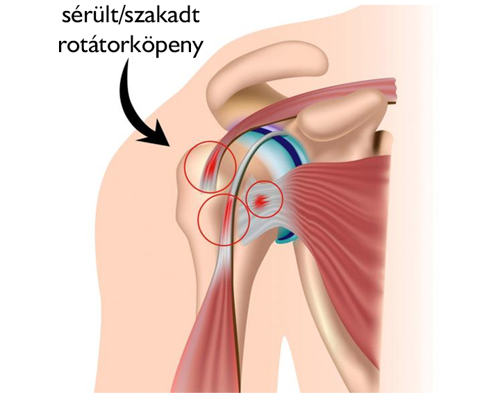 Rotátorköpeny rekonstrukció
