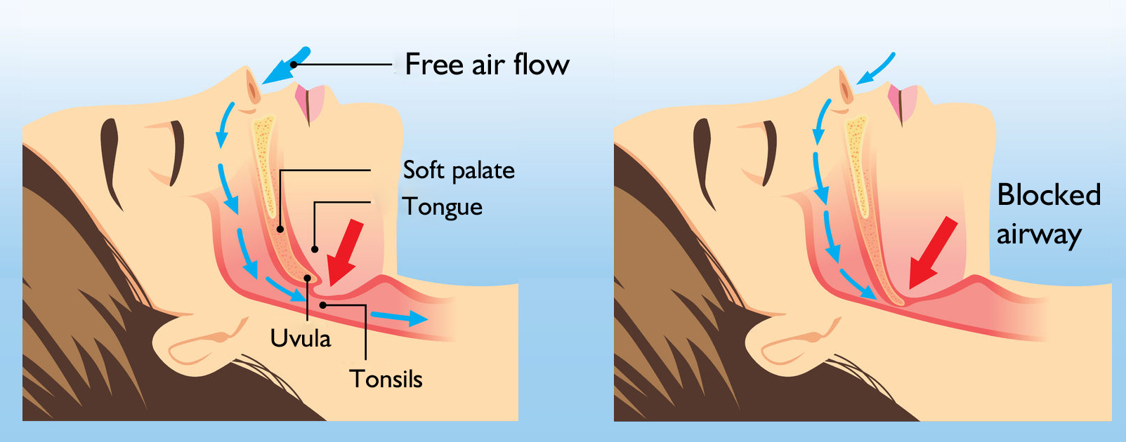 snoring