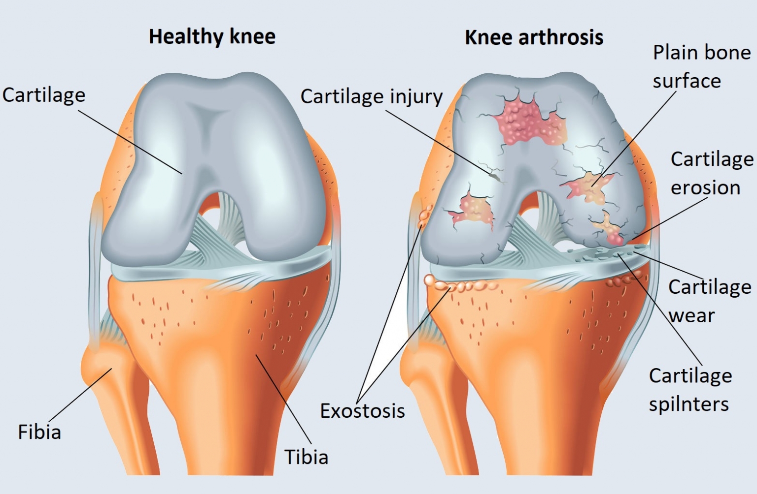 knee arthrosis