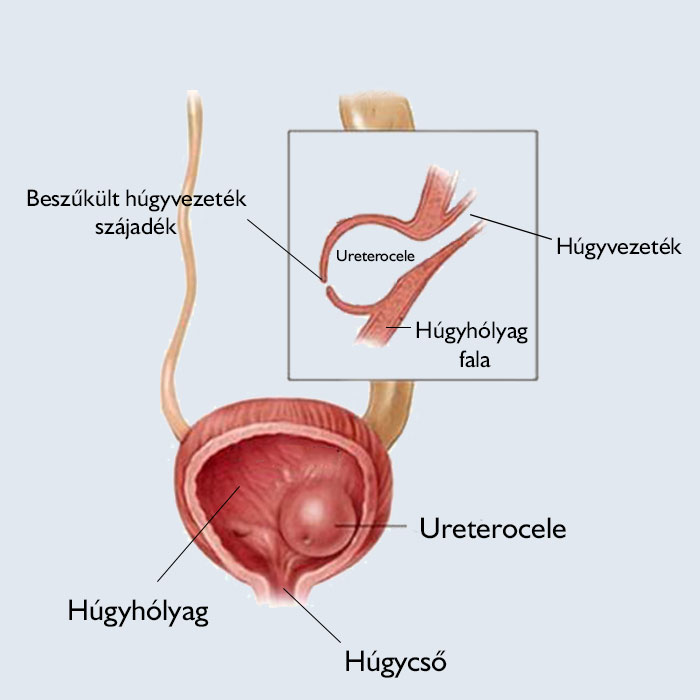 Ureterocele kialakulas