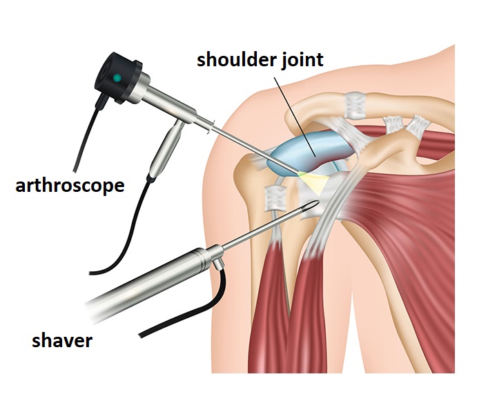 Shoulder surgery