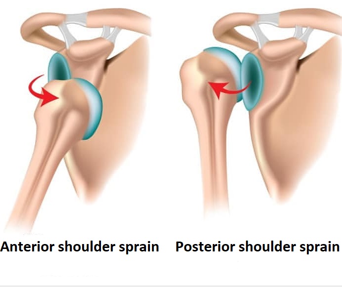 Shoulder sprain