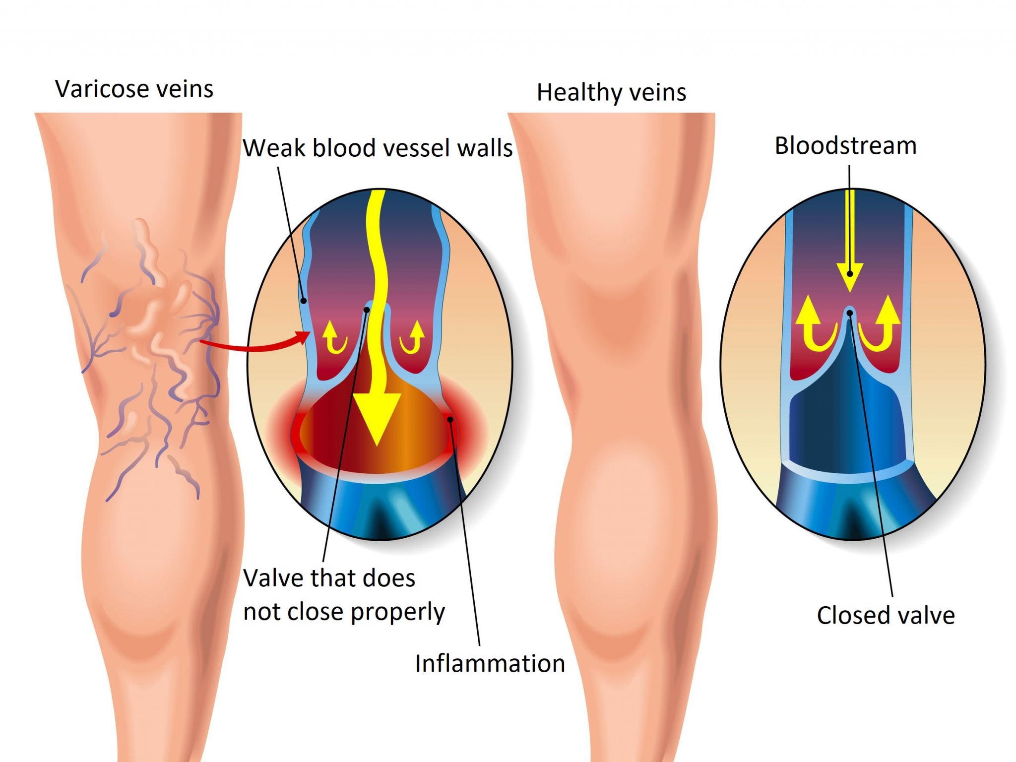 EVLA