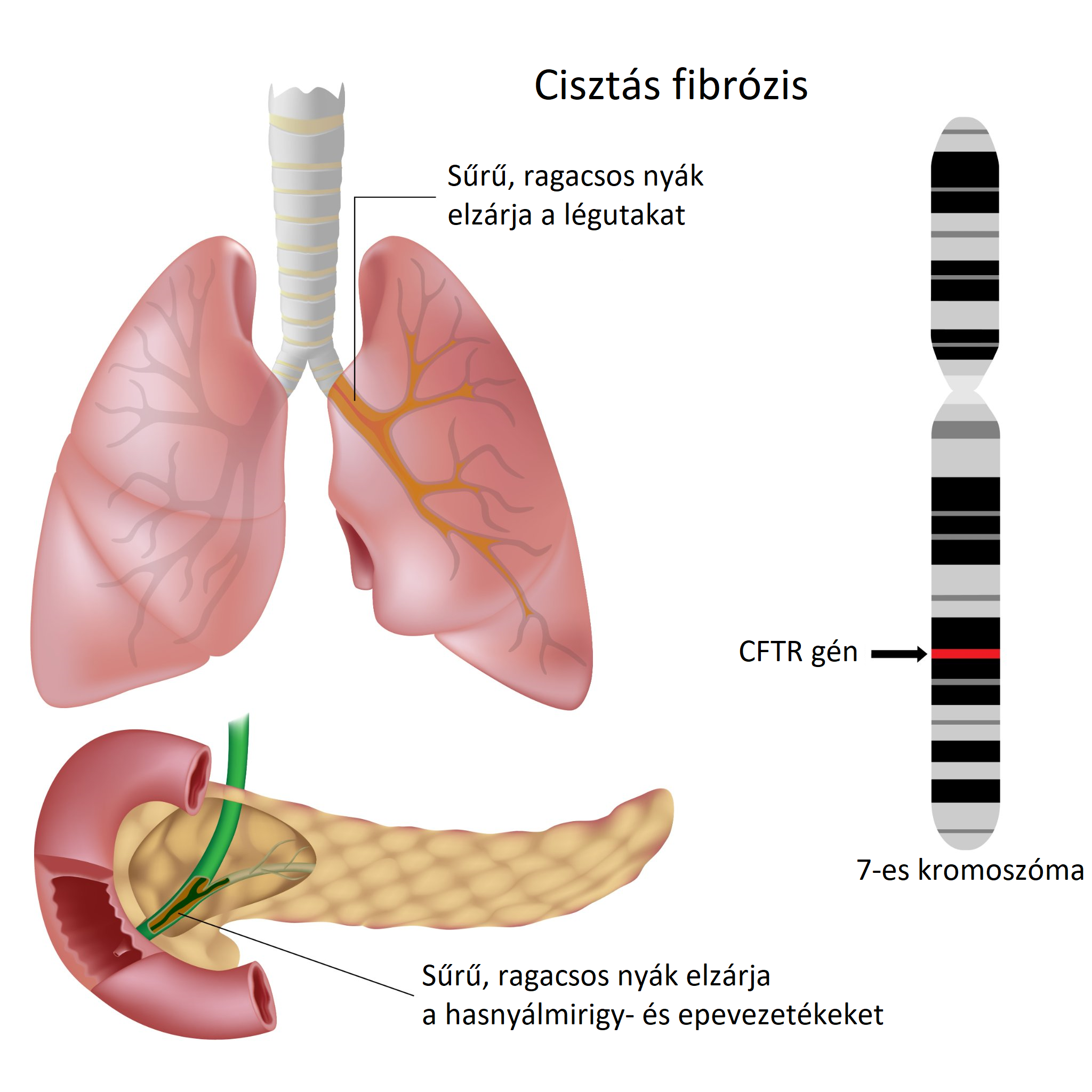 cisztás fibrózis