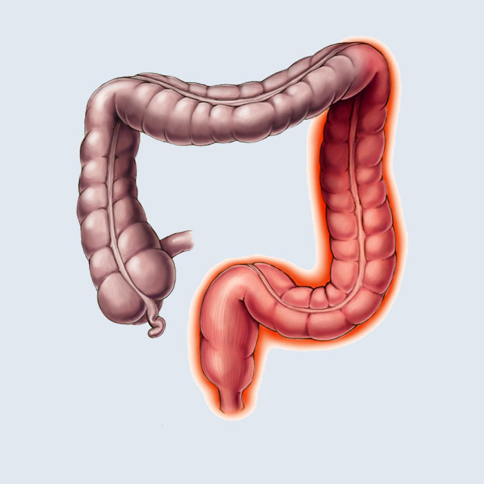 colitis ulcerosa
