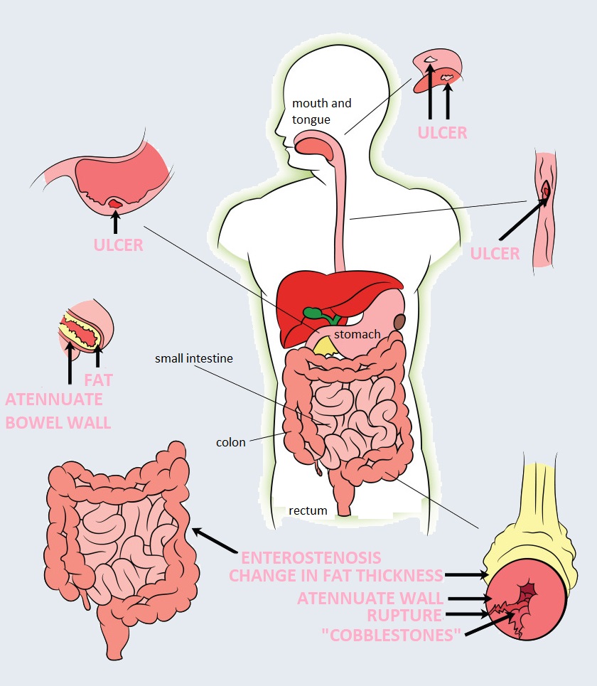 crohn's disease