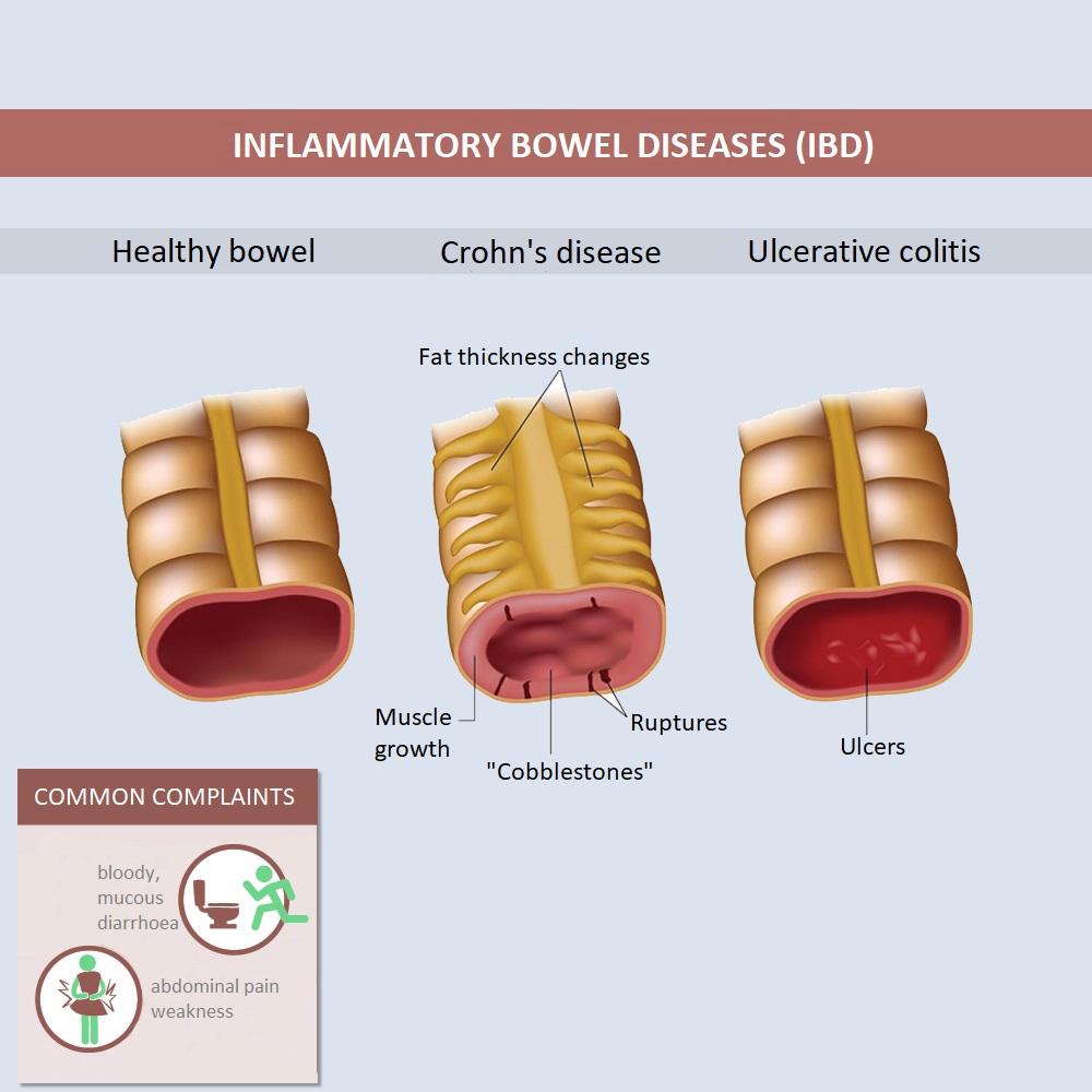 ibs