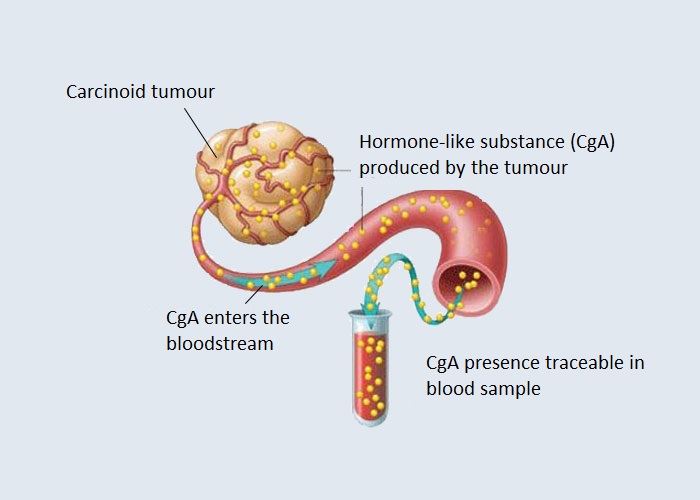 karcinoid tumor