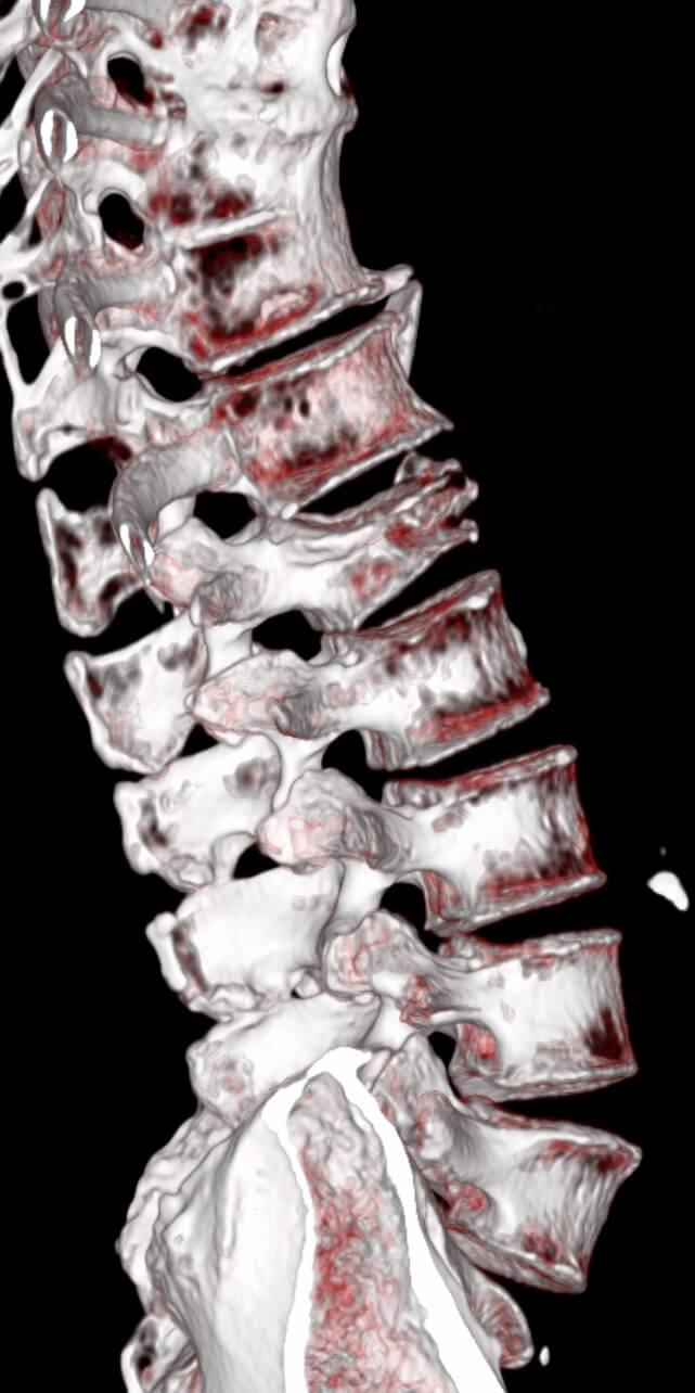 Gerinc CT