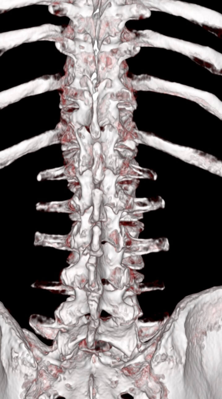 Gerinc CT