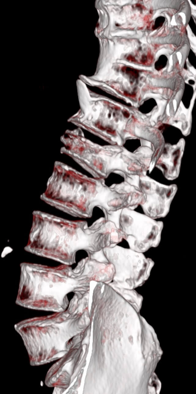 Gerinc CT