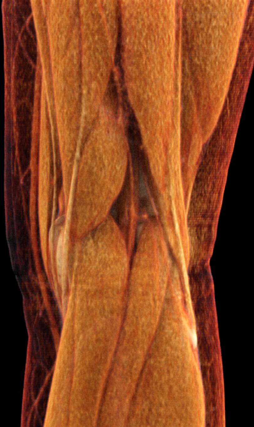 Térd CT