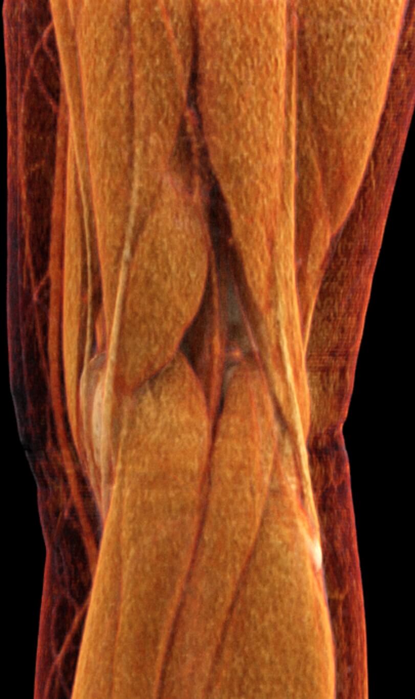 Térd CT