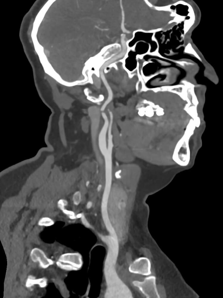 Vascularis CT felvétel