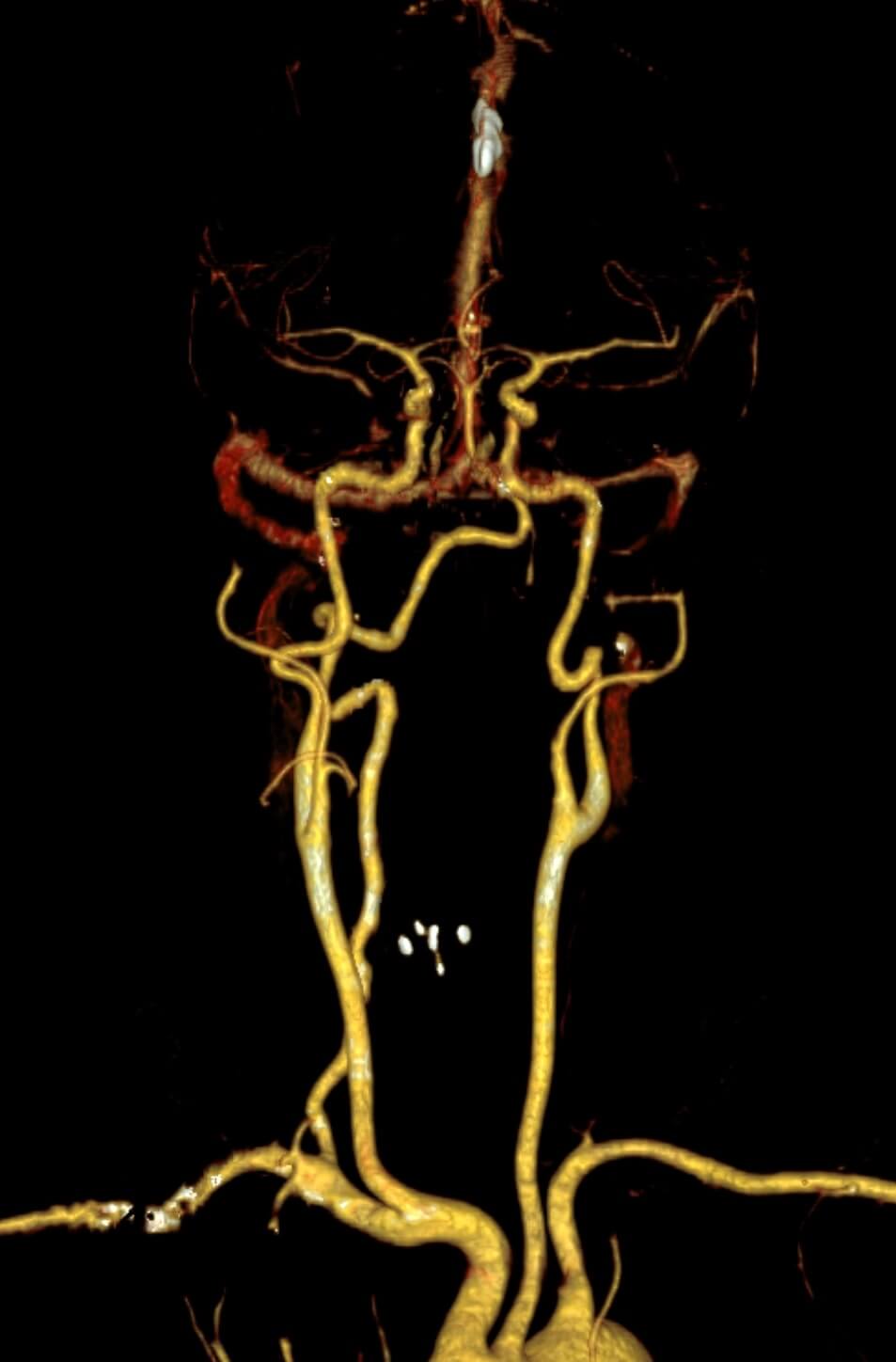 Vascularis CT felvétel