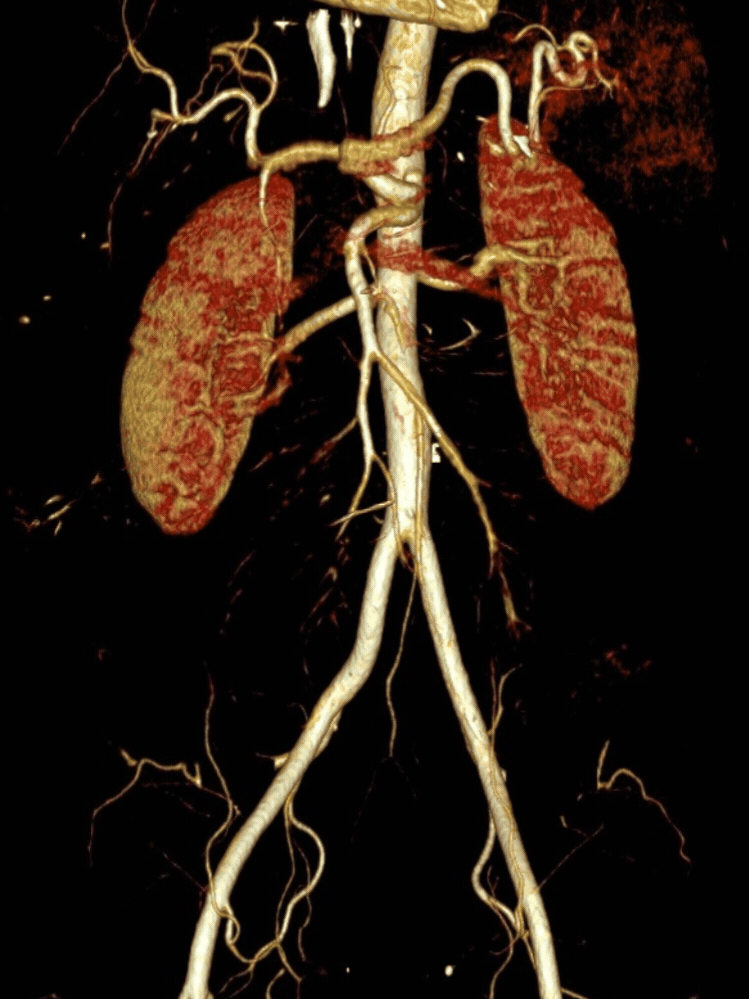 CT angiogram animáció