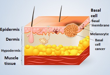 Basal-cell carcinoma