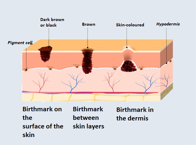 Birthmark
