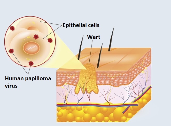 Wart