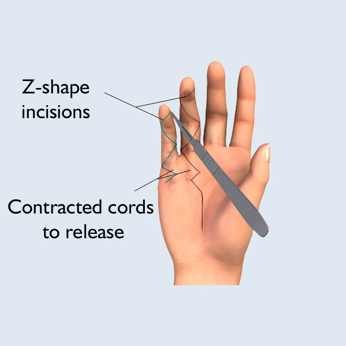 Dupuytren surgery