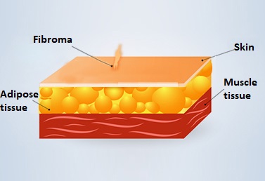 Fibroma