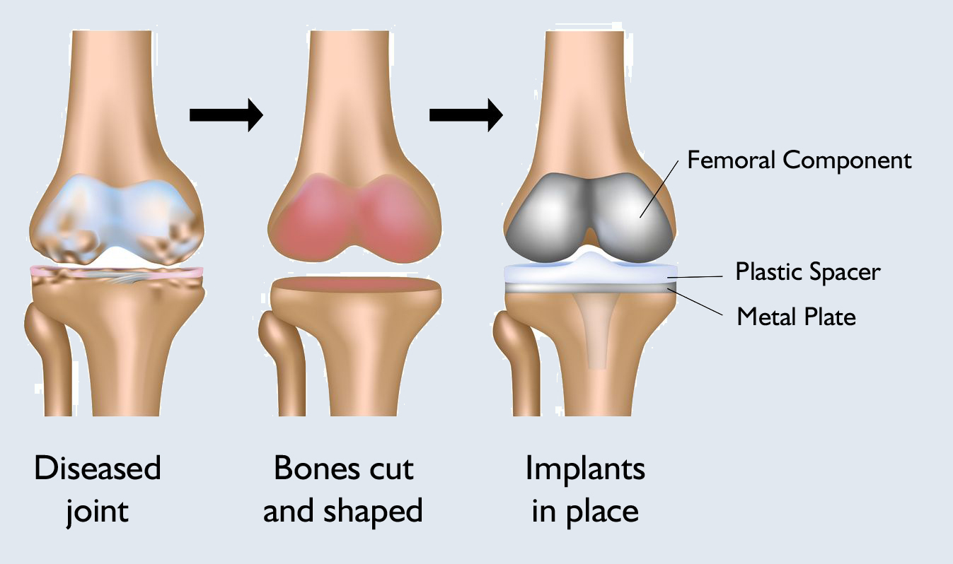 Knee replacement