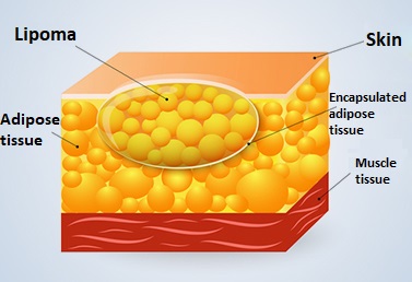 Lipoma