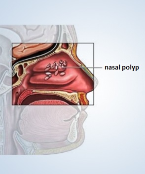 nasal polyp