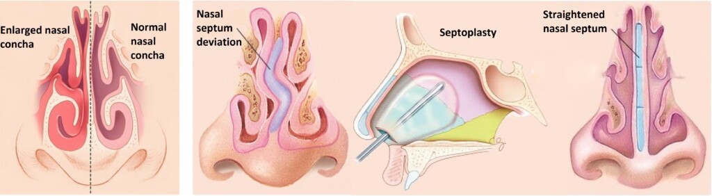 septoplasty