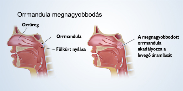 Orrmandula megnagyobbodás
