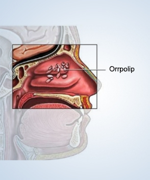 Orrpolip