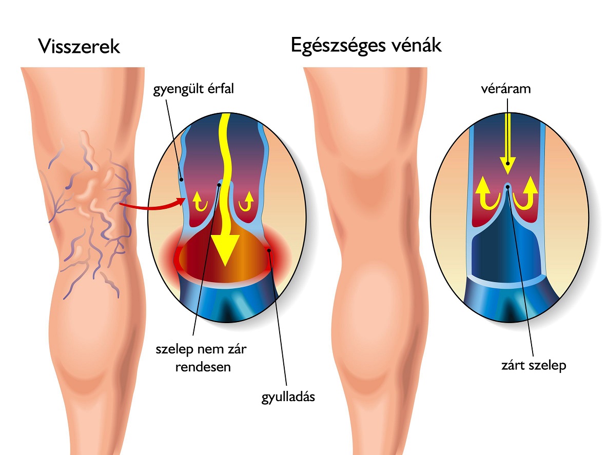Visszerek és egészséges vénák