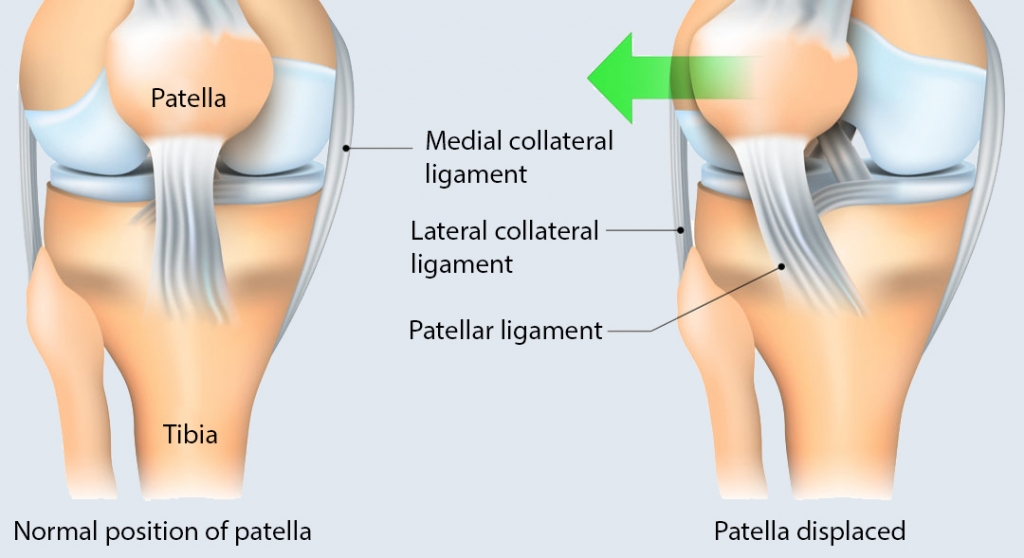 patella removal